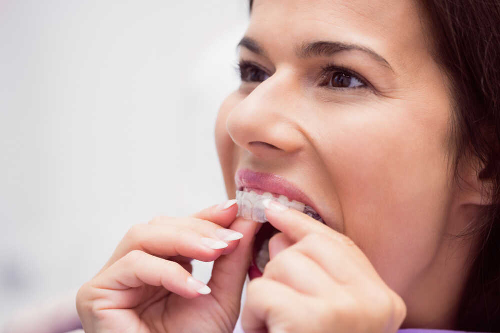 Pacjentka Invisalign zakładka nakładki na zęby